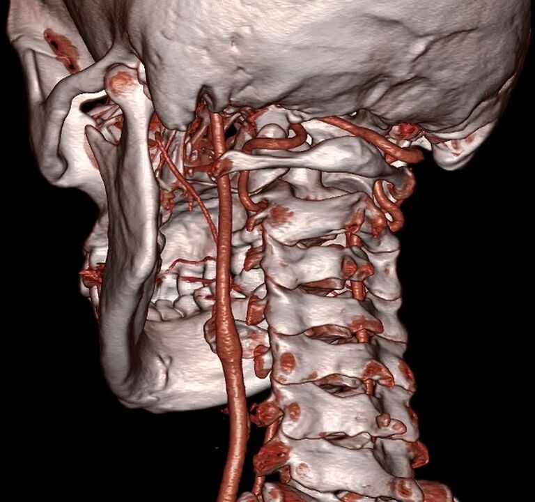arteri mencubit dengan osteochondrosis serviks