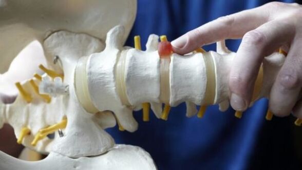 hernia tulang belakang sebagai penyebab sakit belakang
