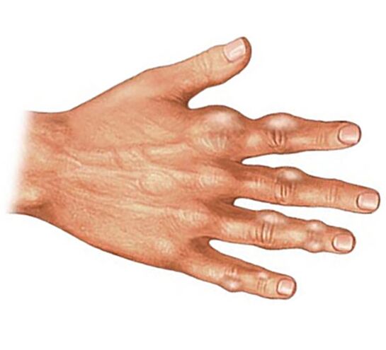 Pemendapan kristal asid urik dalam tisu lembut jari dengan arthritis gout