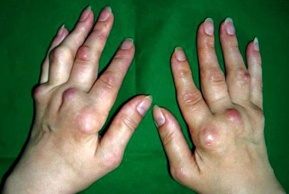 Tangan terjejas oleh deformans polyosteoarthritis