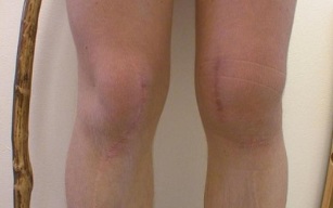peringkat perkembangan arthrosis lutut