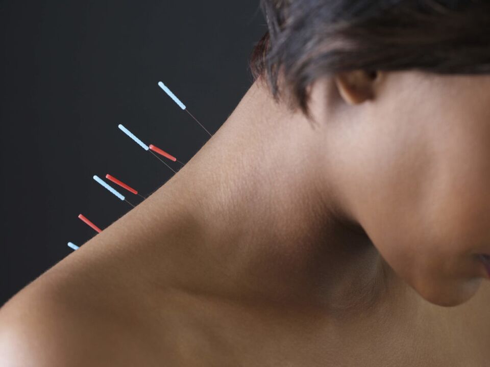 Akupunktur untuk osteochondrosis serviks menghapuskan proses keradangan