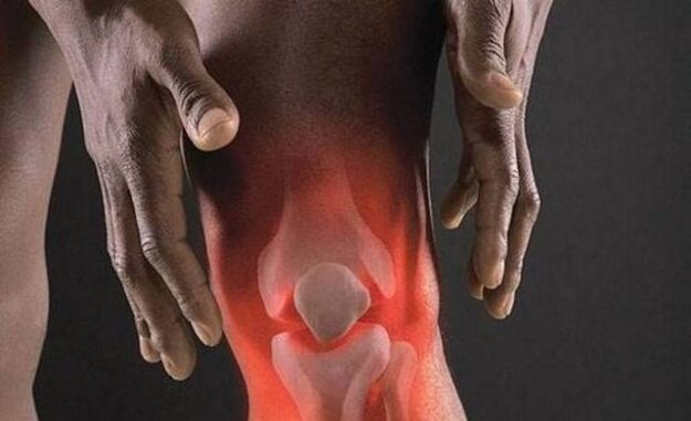 Arthrosis disertai dengan proses keradangan pada sendi lutut
